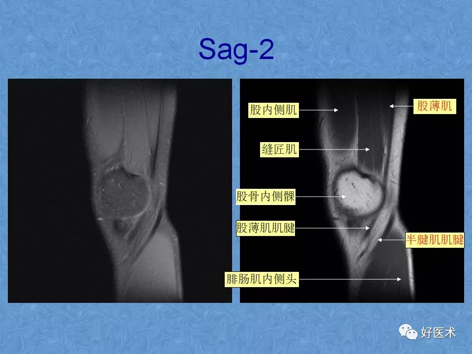 影像PPT - 【PPT】膝关节MRI正常解剖-7