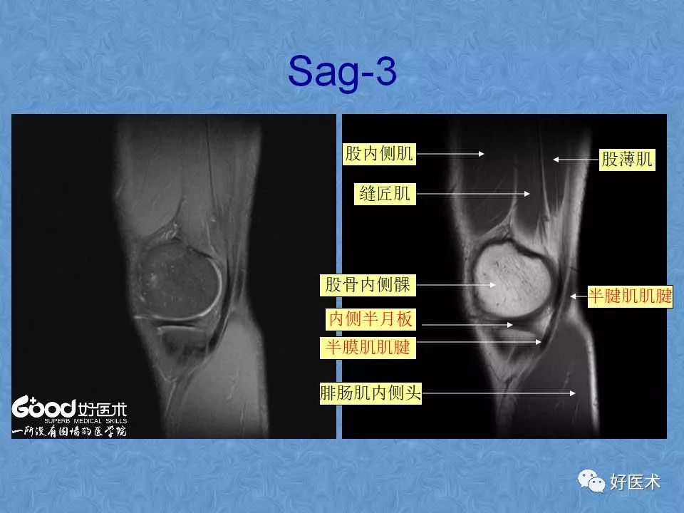 影像PPT - 【PPT】膝关节MRI正常解剖-8