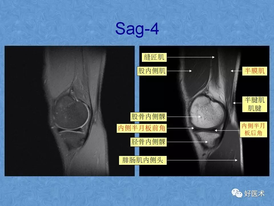 影像PPT - 【PPT】膝关节MRI正常解剖-9