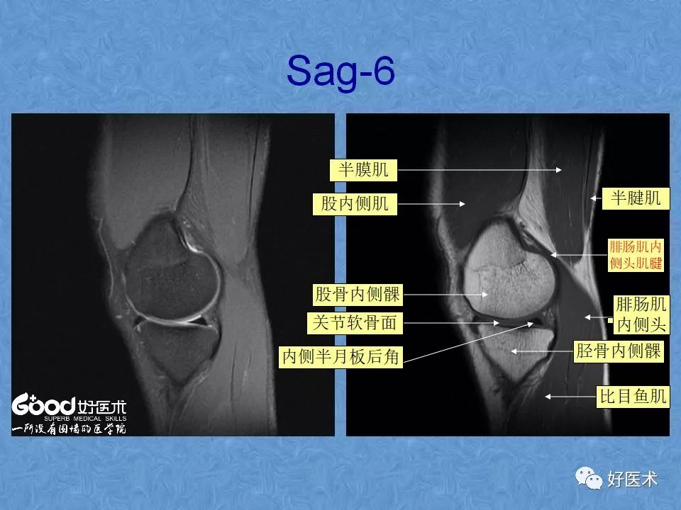影像PPT - 【PPT】膝关节MRI正常解剖-11