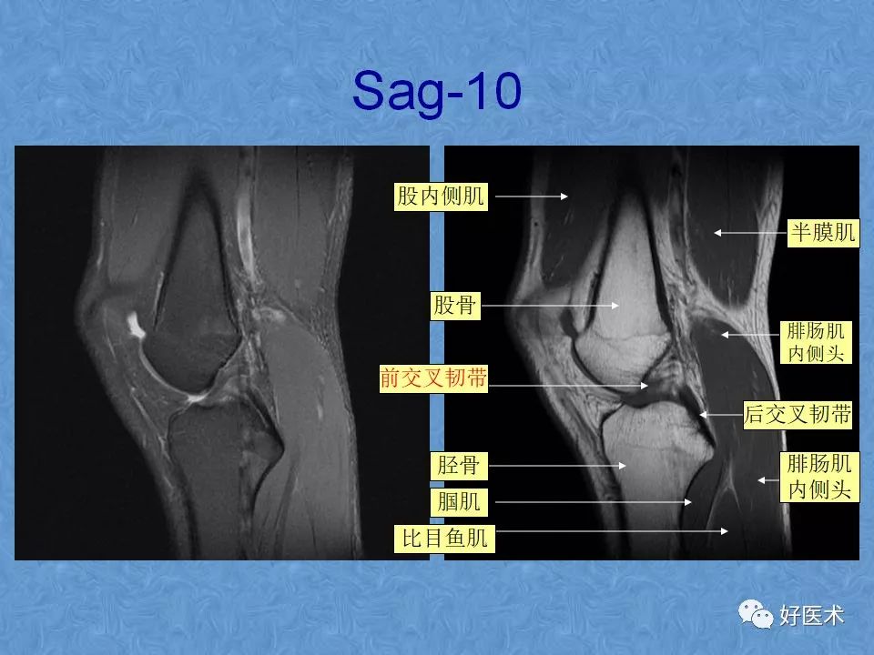 影像PPT - 【PPT】膝关节MRI正常解剖-14