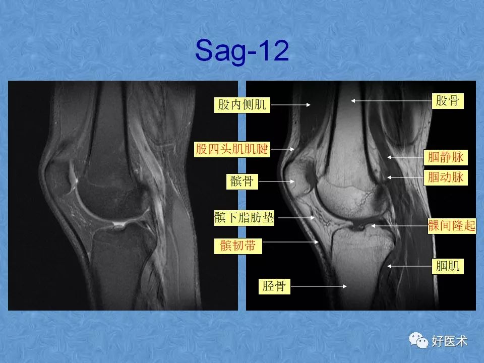 影像PPT - 【PPT】膝关节MRI正常解剖-16