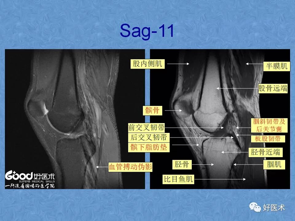 影像PPT - 【PPT】膝关节MRI正常解剖-15