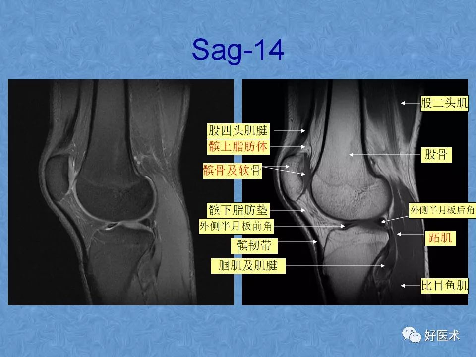 影像PPT - 【PPT】膝关节MRI正常解剖-18