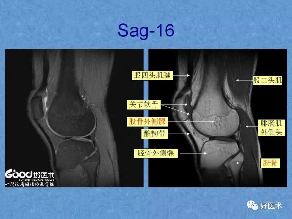 影像PPT - 【PPT】膝关节MRI正常解剖-20