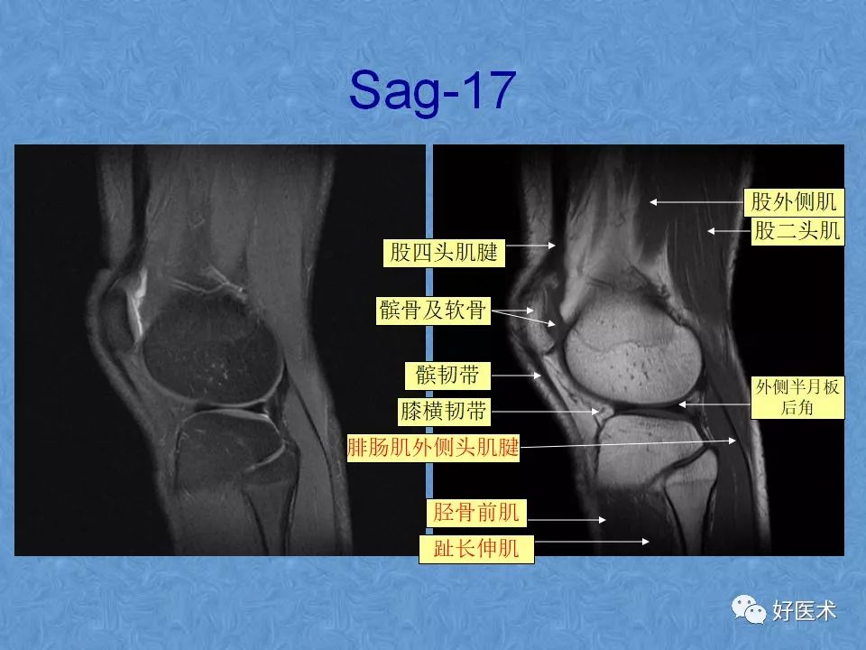 影像PPT - 【PPT】膝关节MRI正常解剖-21