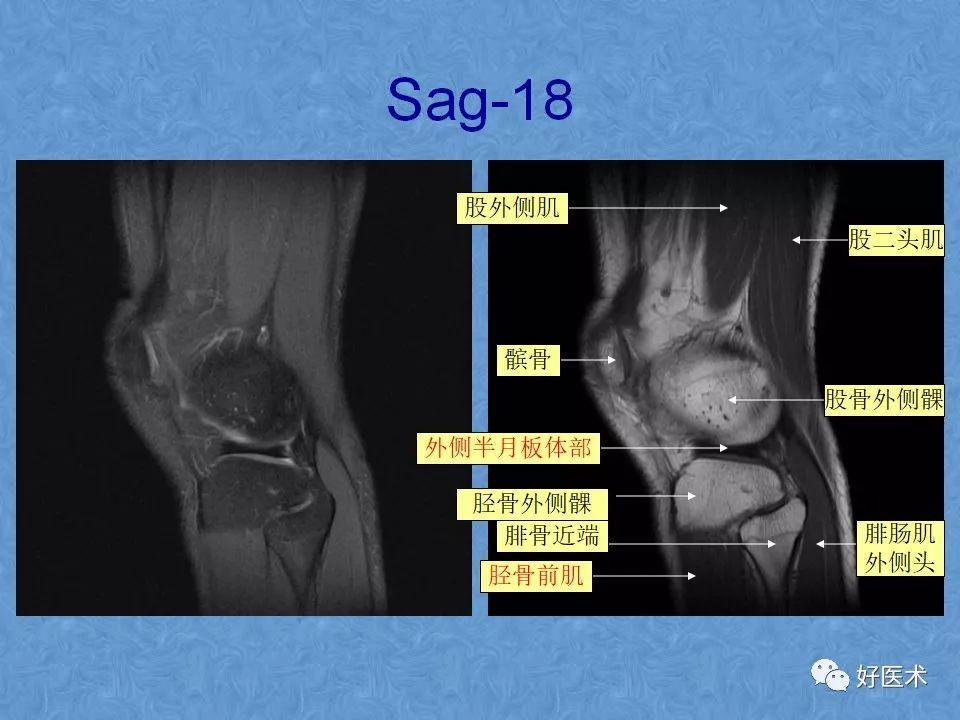 影像PPT - 【PPT】膝关节MRI正常解剖-22