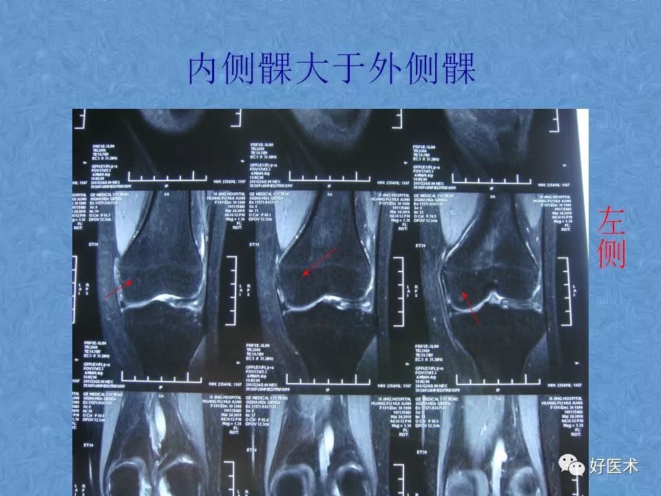 影像PPT - 【PPT】膝关节MRI正常解剖-25