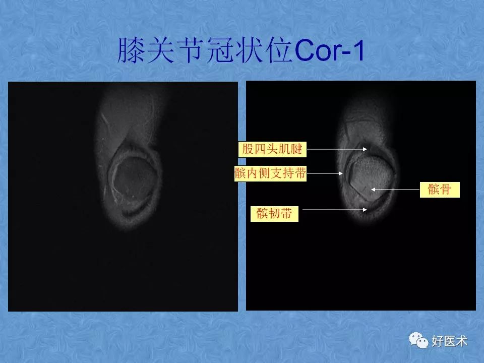 影像PPT - 【PPT】膝关节MRI正常解剖-27