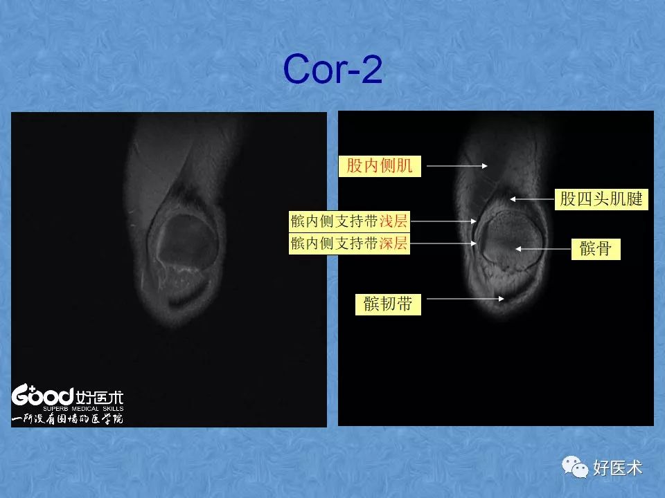 影像PPT - 【PPT】膝关节MRI正常解剖-28