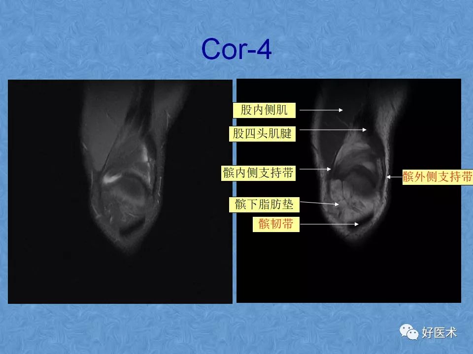 影像PPT - 【PPT】膝关节MRI正常解剖-30