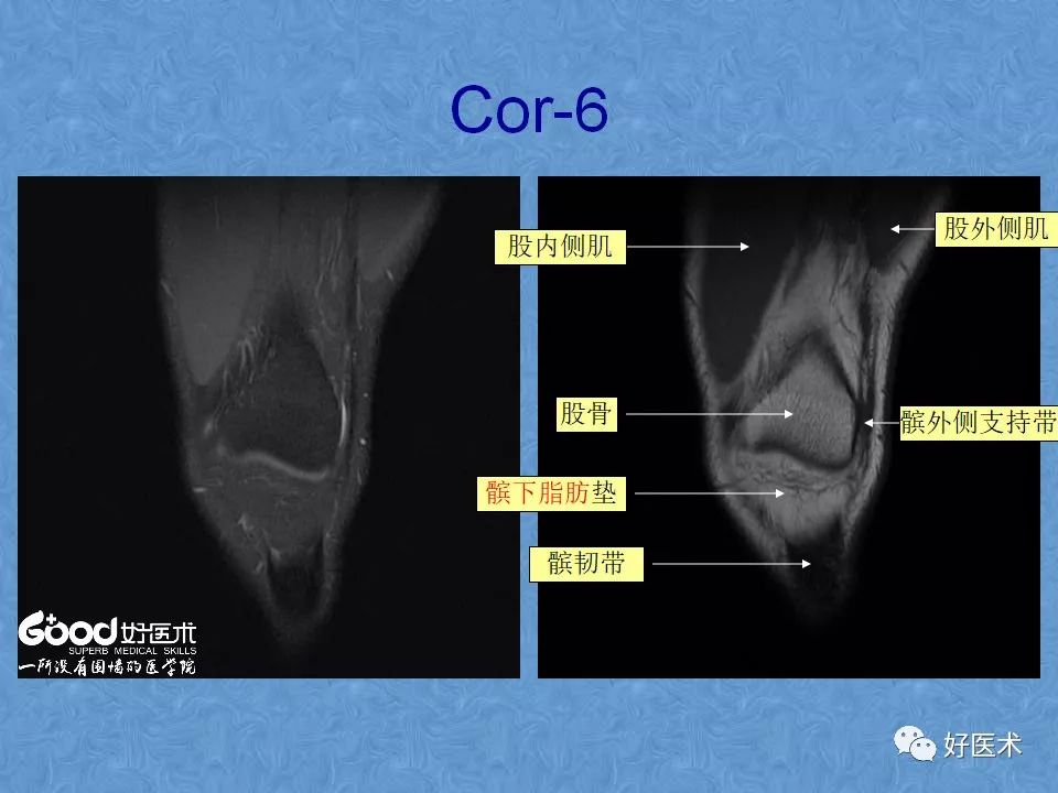 影像PPT - 【PPT】膝关节MRI正常解剖-32