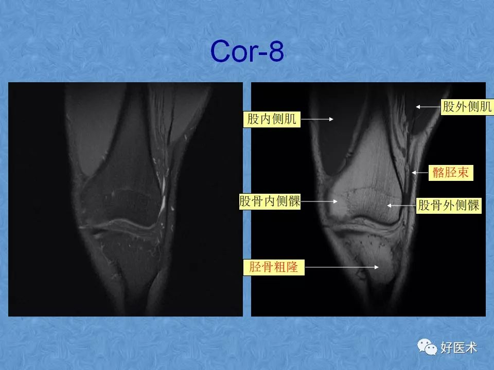影像PPT - 【PPT】膝关节MRI正常解剖-33