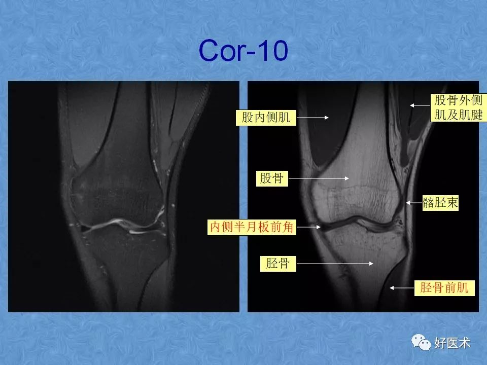 影像PPT - 【PPT】膝关节MRI正常解剖-34