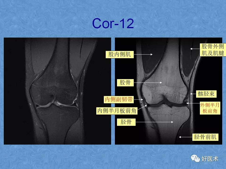 影像PPT - 【PPT】膝关节MRI正常解剖-35