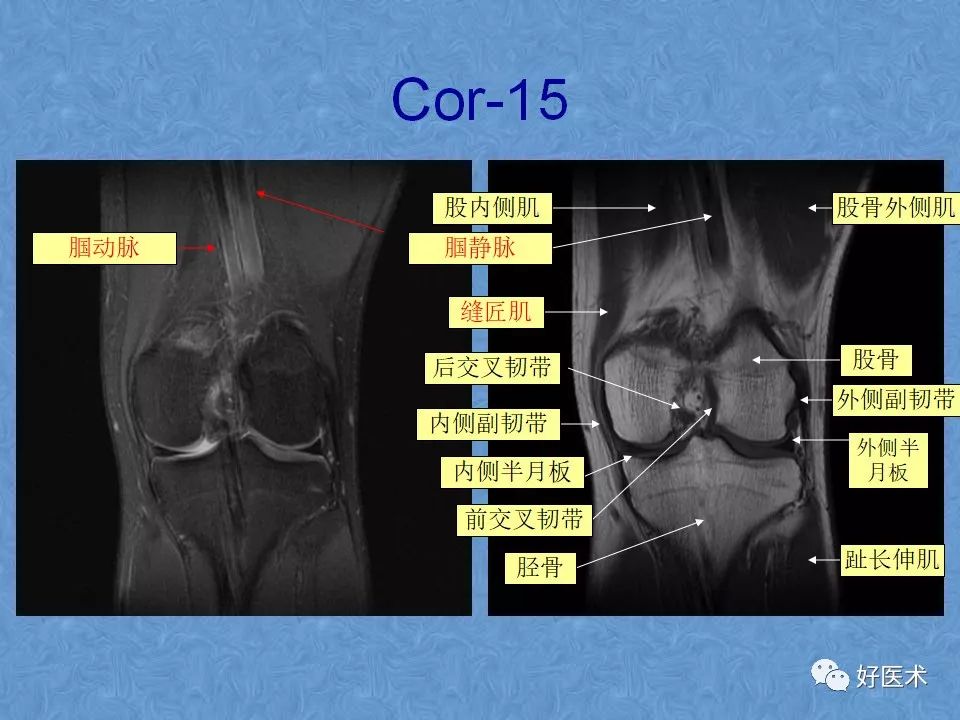 影像PPT - 【PPT】膝关节MRI正常解剖-38