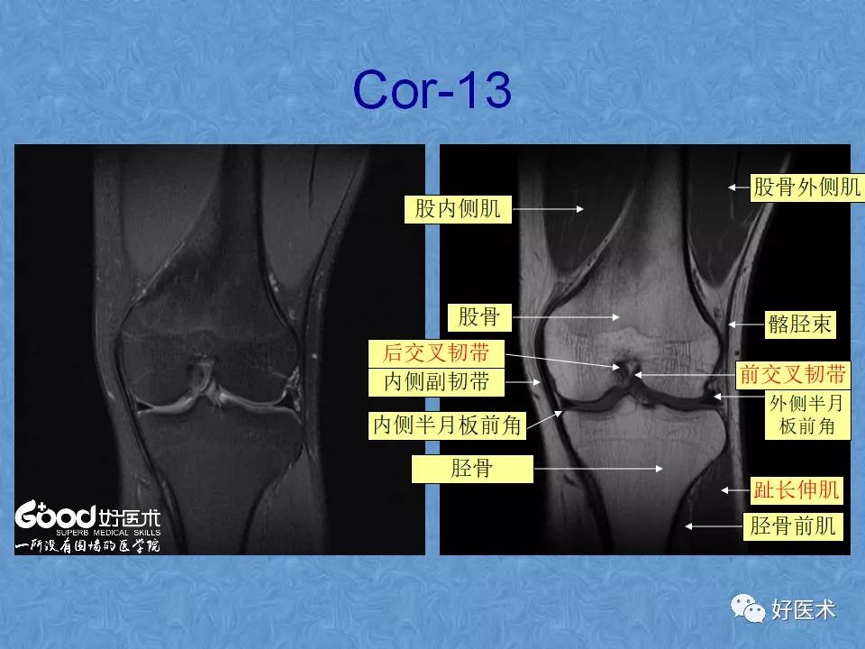 影像PPT - 【PPT】膝关节MRI正常解剖-36