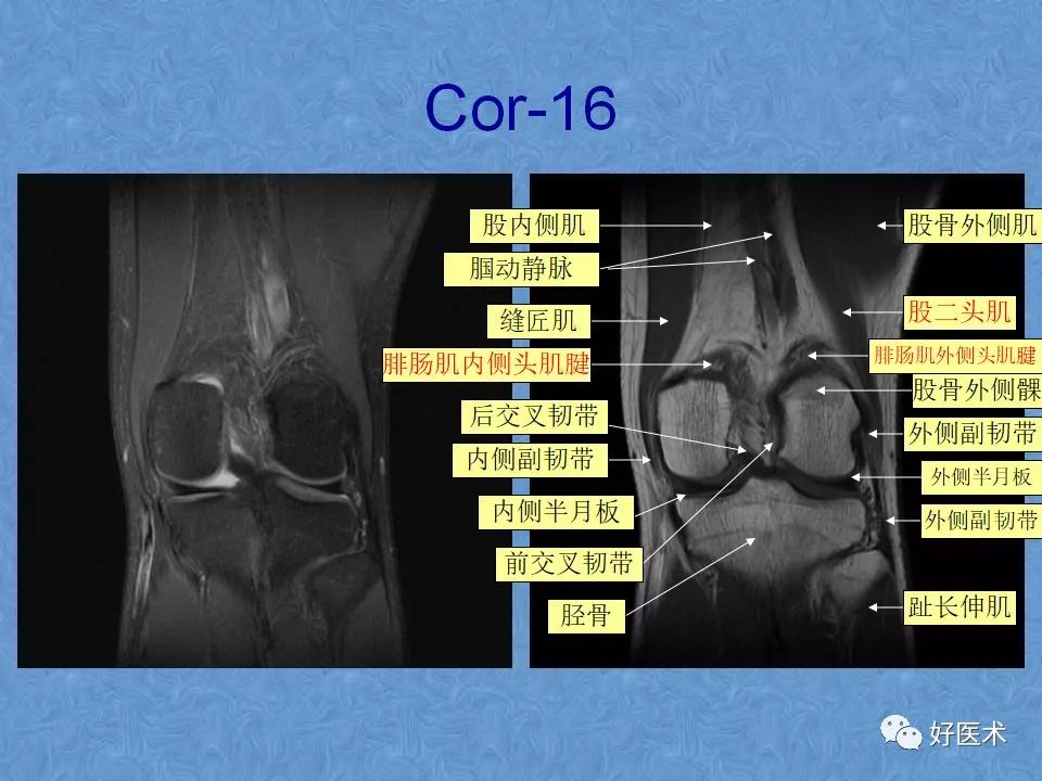 影像PPT - 【PPT】膝关节MRI正常解剖-39