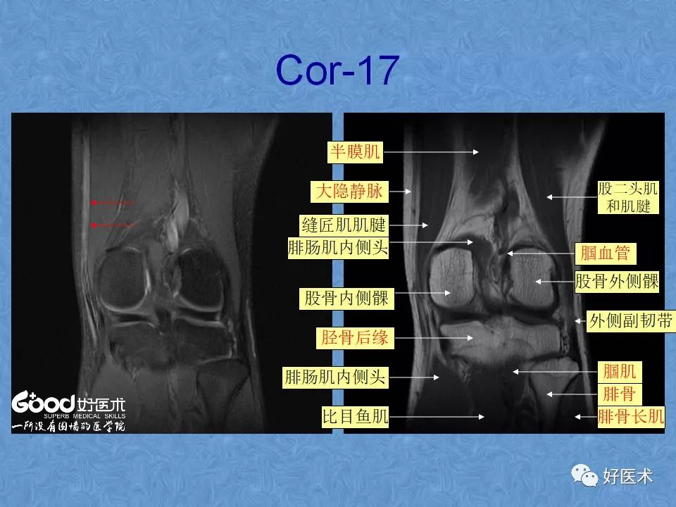 影像PPT - 【PPT】膝关节MRI正常解剖-40