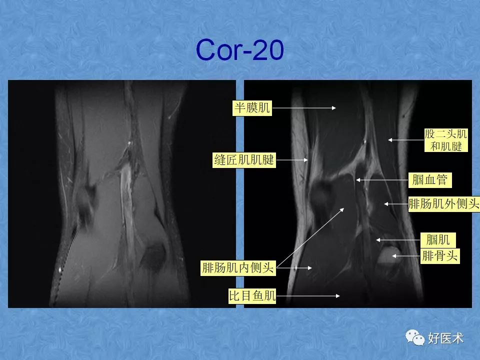 影像PPT - 【PPT】膝关节MRI正常解剖-42