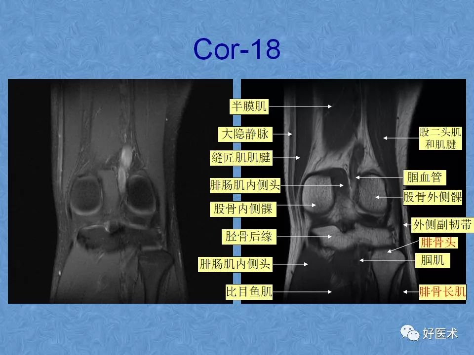 影像PPT - 【PPT】膝关节MRI正常解剖-41