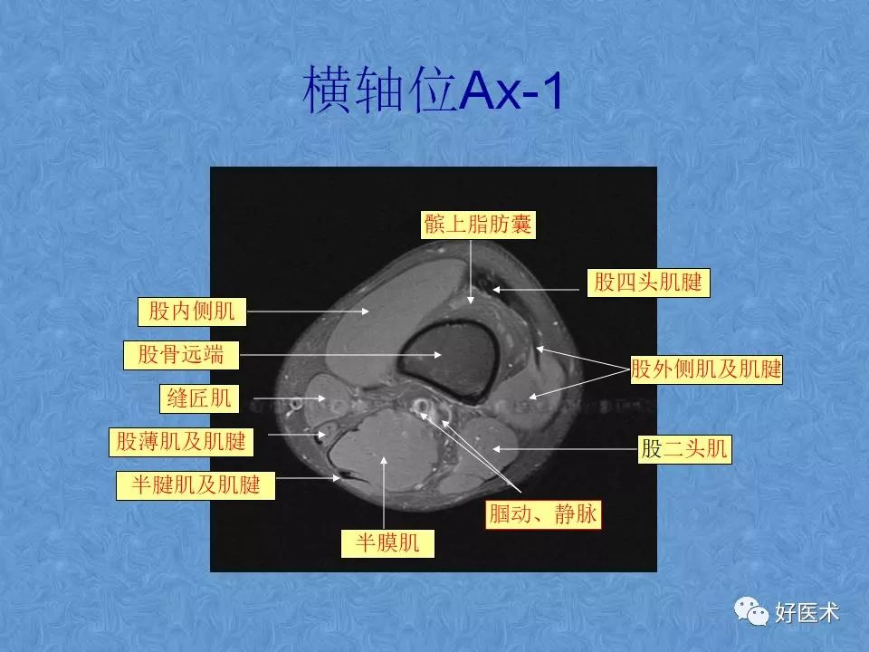影像PPT - 【PPT】膝关节MRI正常解剖-44