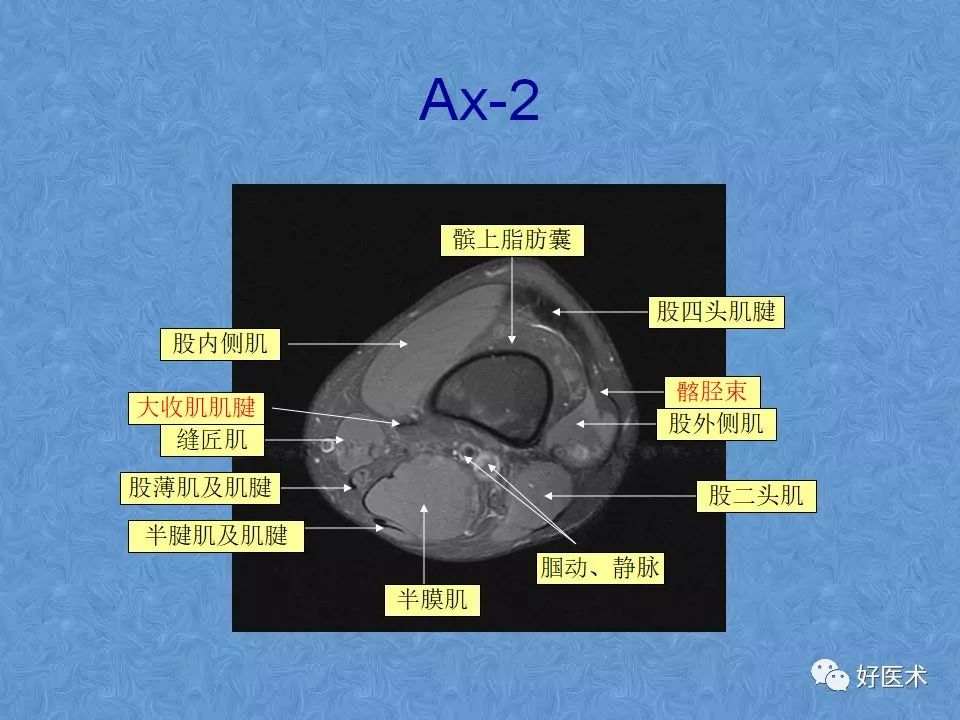 影像PPT - 【PPT】膝关节MRI正常解剖-45