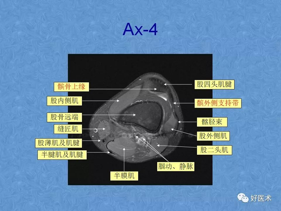 影像PPT - 【PPT】膝关节MRI正常解剖-46