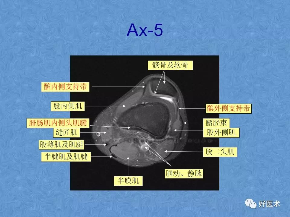 影像PPT - 【PPT】膝关节MRI正常解剖-47