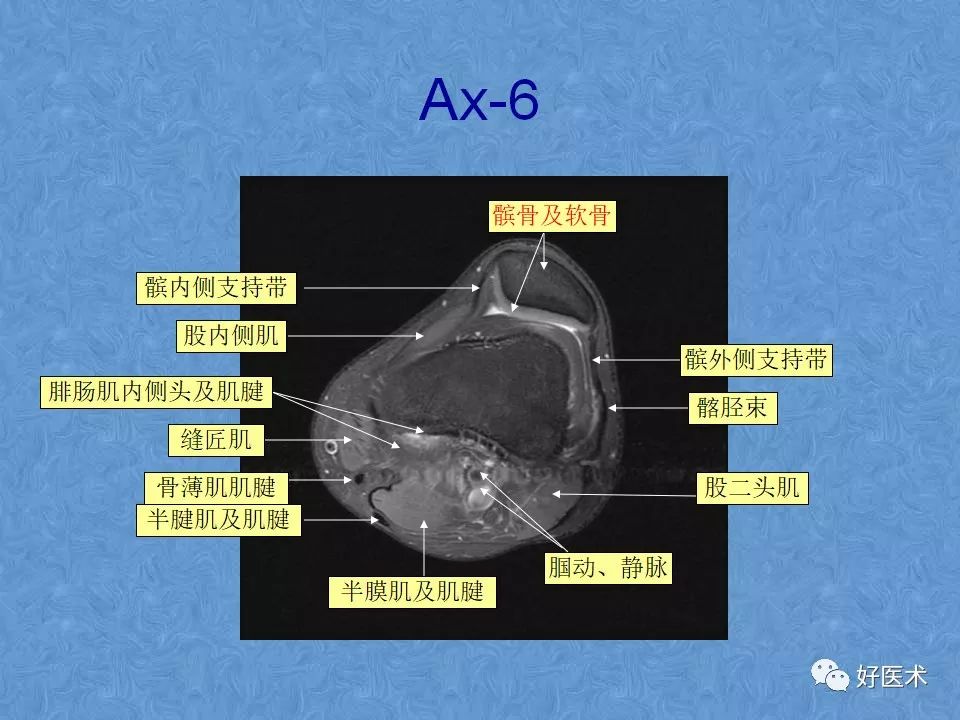 影像PPT - 【PPT】膝关节MRI正常解剖-48