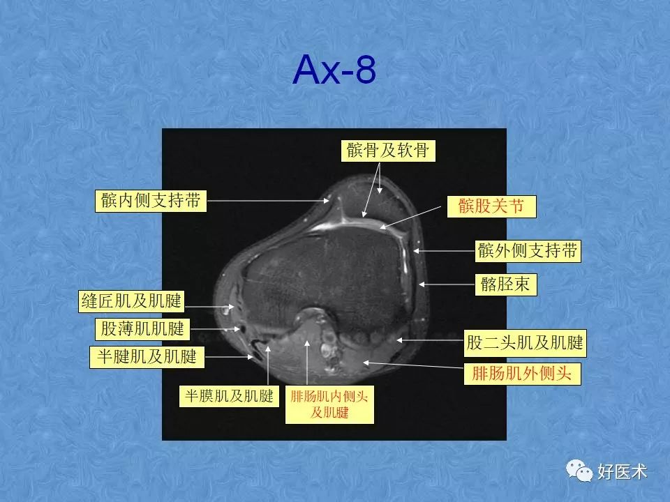 影像PPT - 【PPT】膝关节MRI正常解剖-50