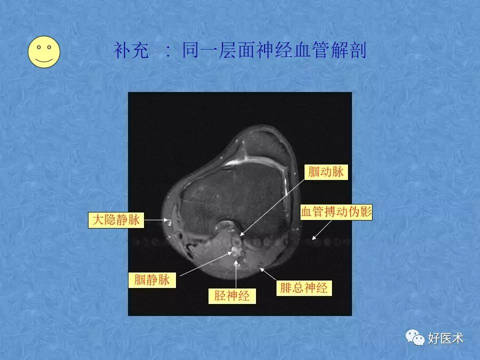 影像PPT - 【PPT】膝关节MRI正常解剖-51