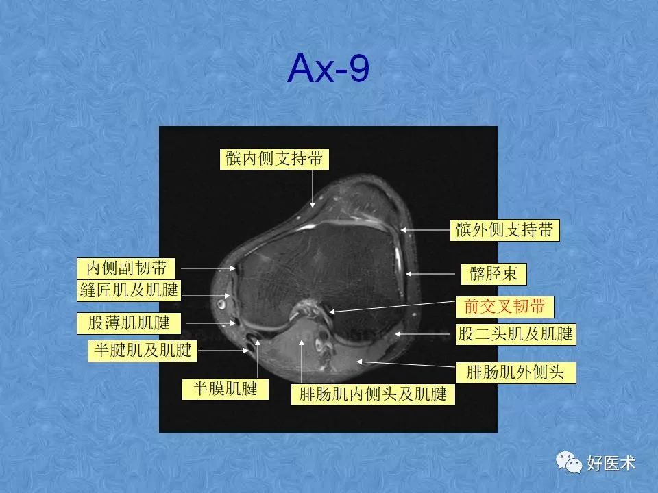 影像PPT - 【PPT】膝关节MRI正常解剖-52