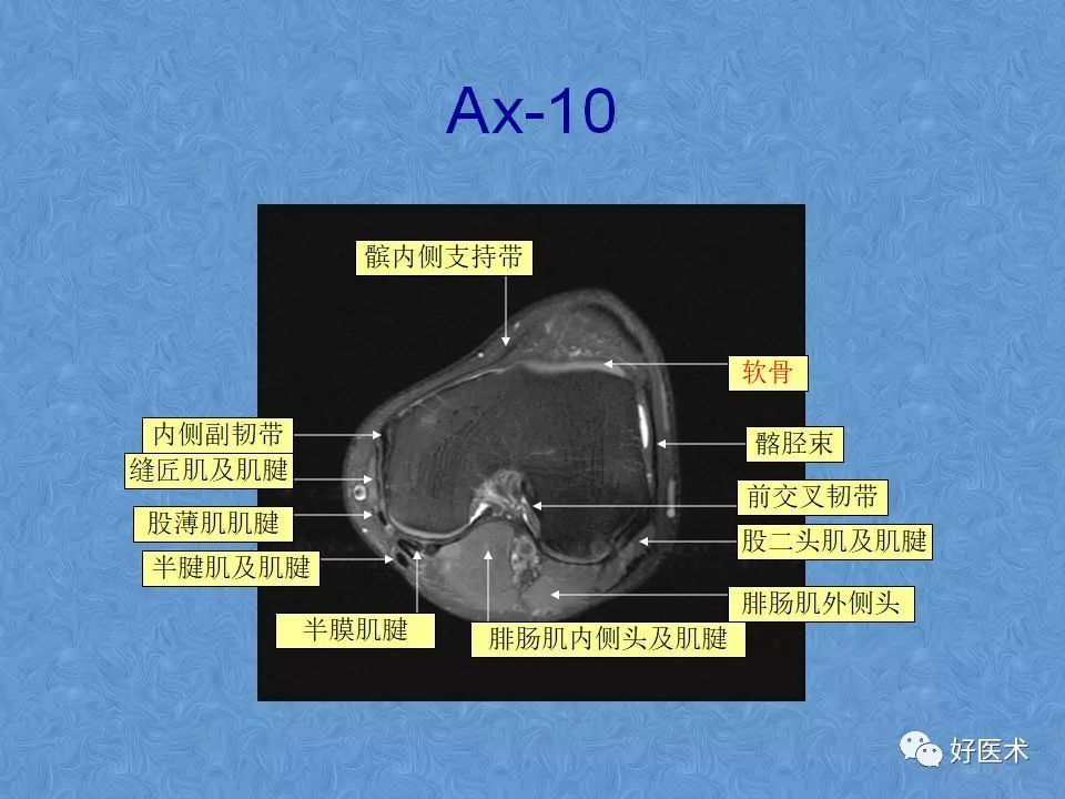 影像PPT - 【PPT】膝关节MRI正常解剖-53