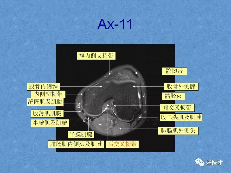 影像PPT - 【PPT】膝关节MRI正常解剖-54