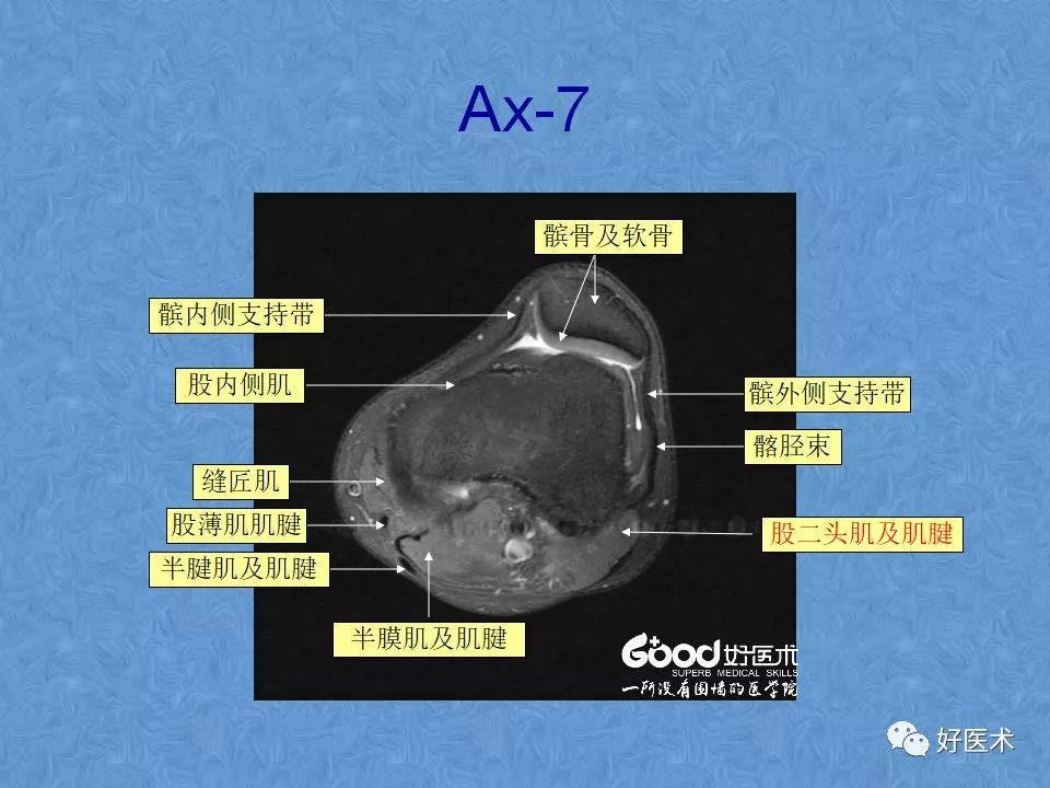 影像PPT - 【PPT】膝关节MRI正常解剖-49