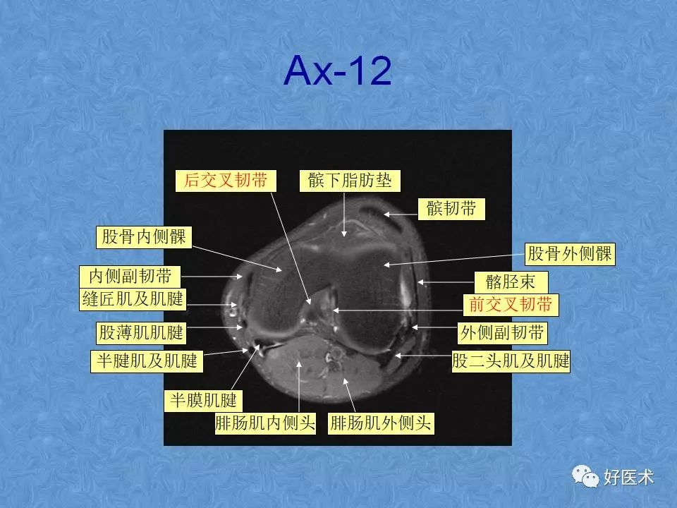 影像PPT - 【PPT】膝关节MRI正常解剖-55