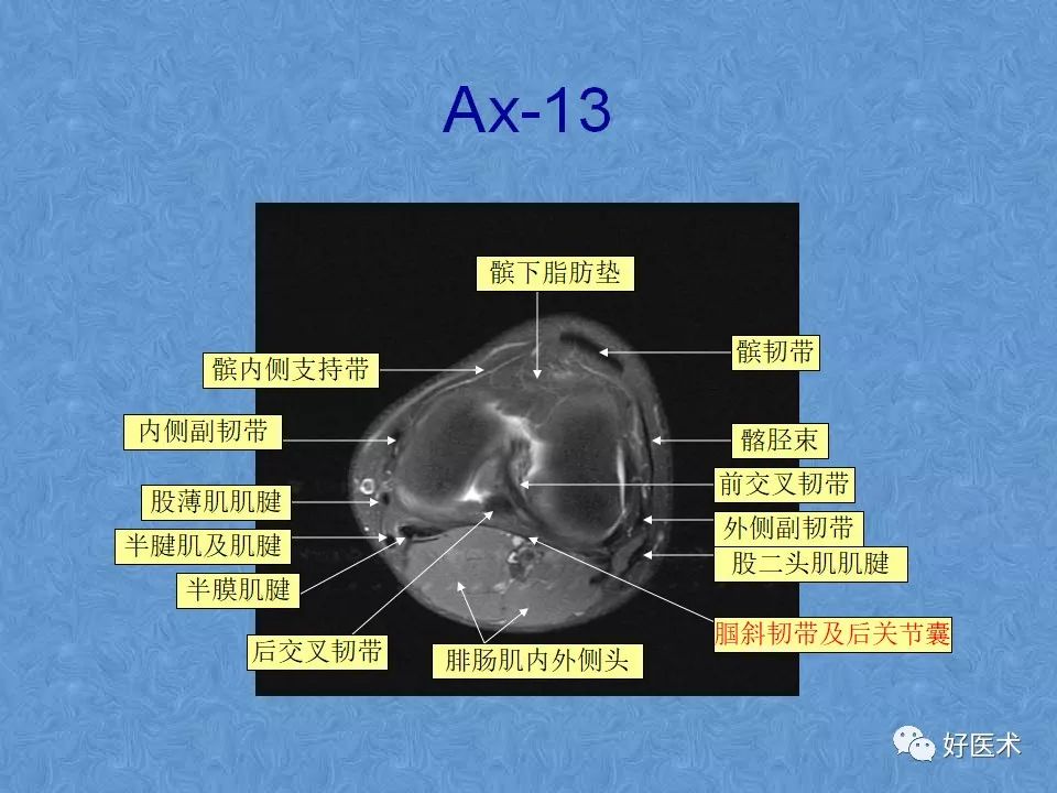 影像PPT - 【PPT】膝关节MRI正常解剖-56