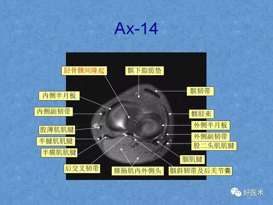 影像PPT - 【PPT】膝关节MRI正常解剖-57