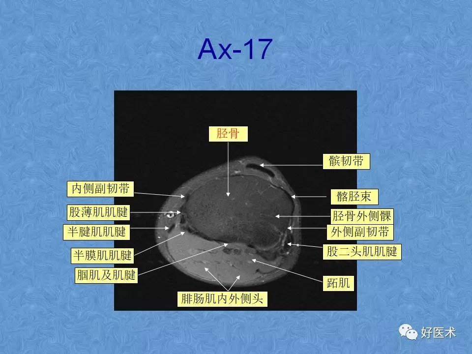 影像PPT - 【PPT】膝关节MRI正常解剖-59