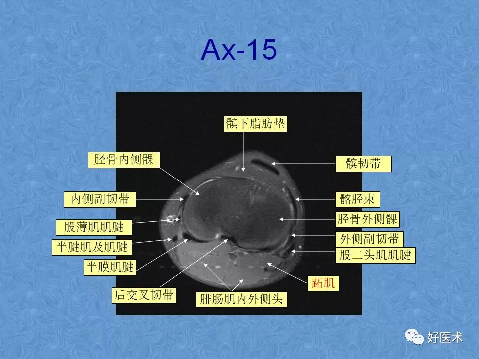 影像PPT - 【PPT】膝关节MRI正常解剖-58