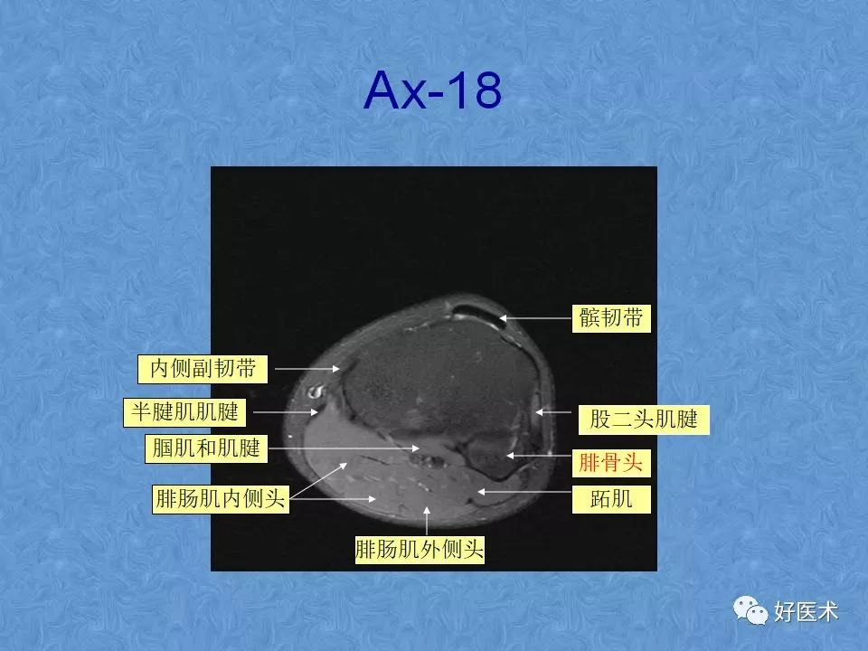 影像PPT - 【PPT】膝关节MRI正常解剖-60