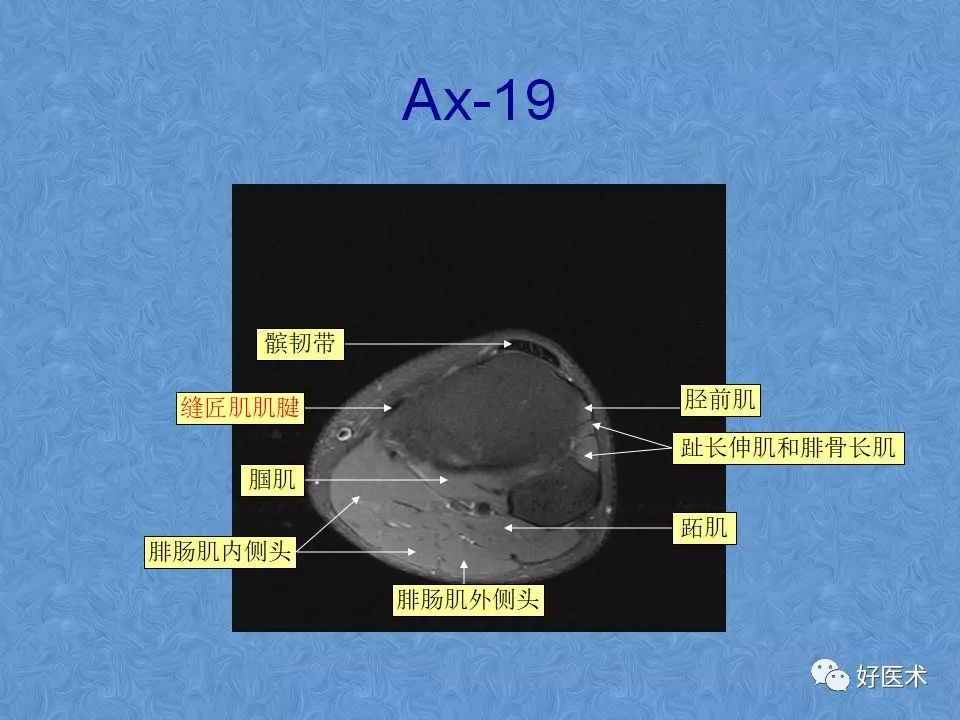影像PPT - 【PPT】膝关节MRI正常解剖-61