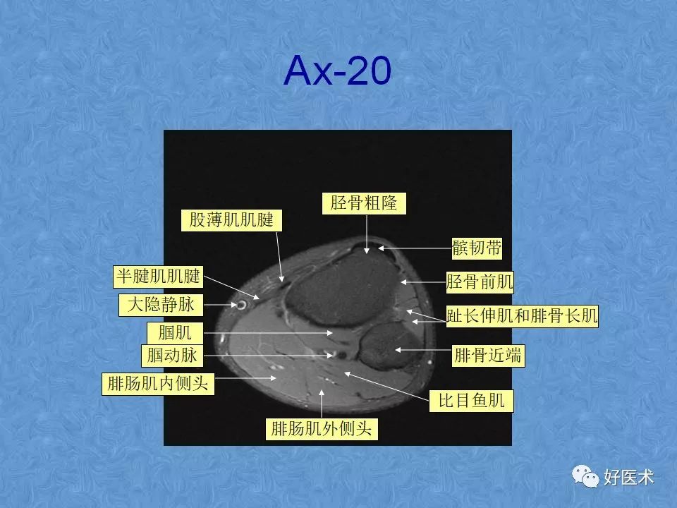 影像PPT - 【PPT】膝关节MRI正常解剖-62