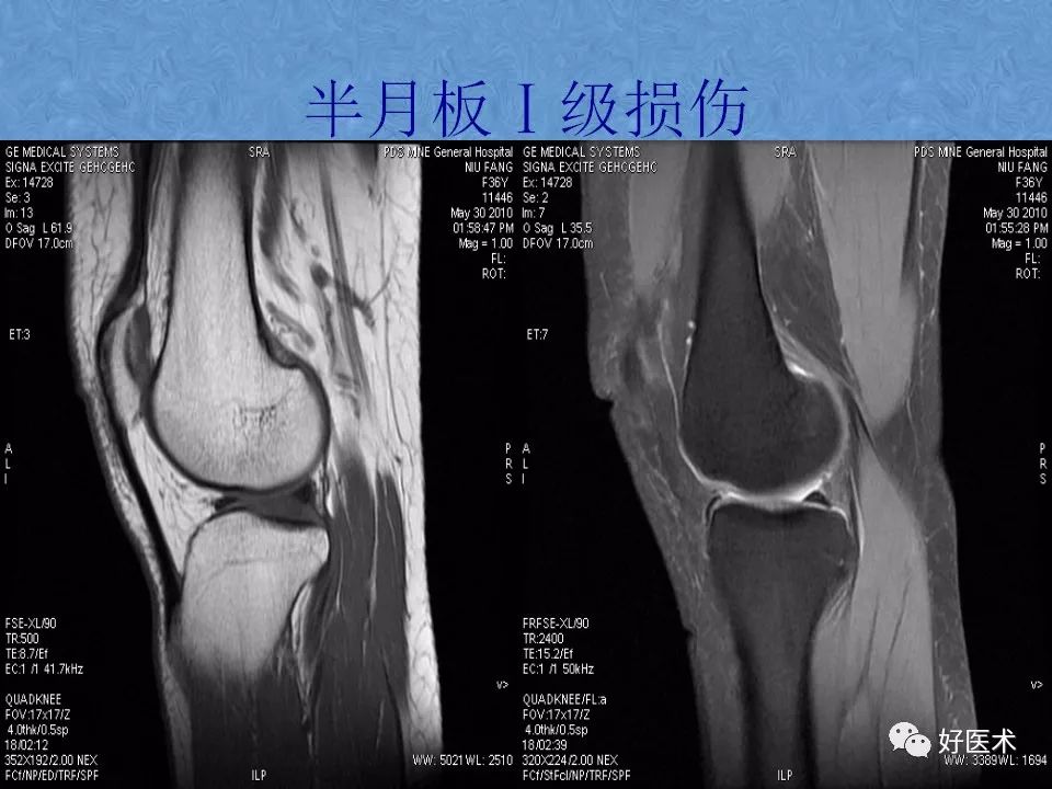 影像PPT - 【PPT】膝关节MRI正常解剖-65