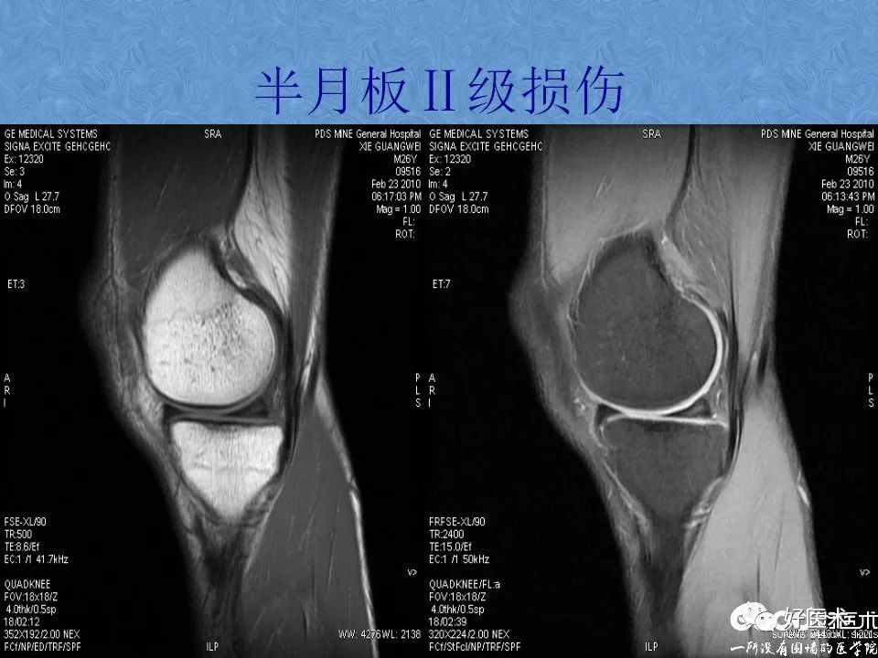 影像PPT - 【PPT】膝关节MRI正常解剖-66