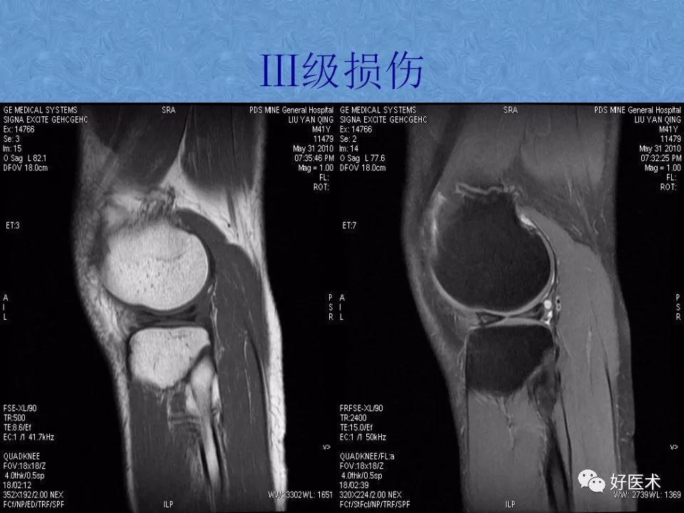 影像PPT - 【PPT】膝关节MRI正常解剖-68