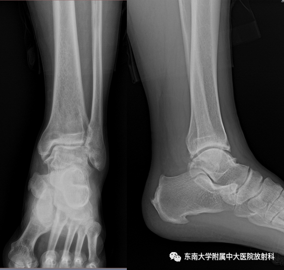 影像PPT - 【PPT】踝关节撞击综合征-1