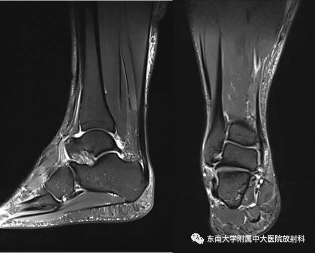 影像PPT - 【PPT】踝关节撞击综合征-2