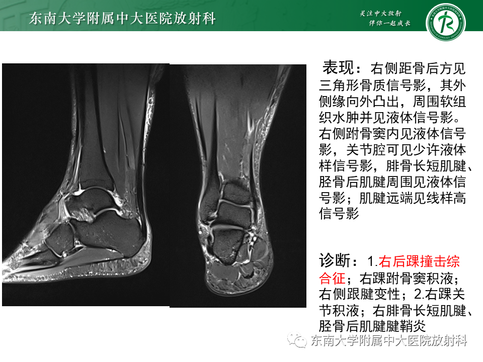 影像PPT - 【PPT】踝关节撞击综合征-4